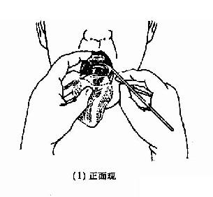 间接喉镜检查法