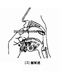 间接喉镜检查法