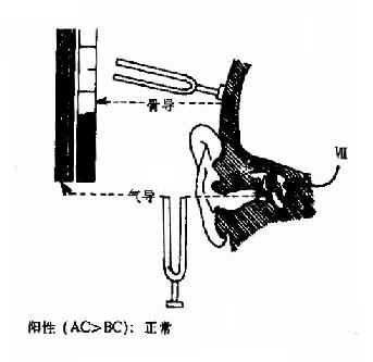 Rinne试验