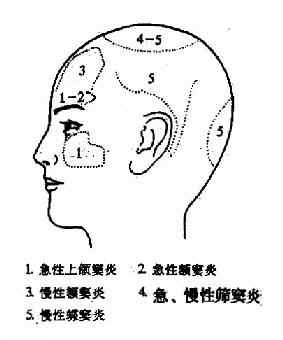 鼻窦炎引起的头痛部位