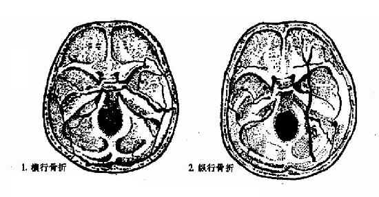 颞骨骨折