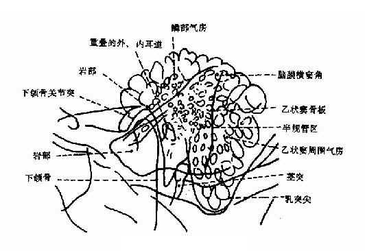 乳突Law氏位