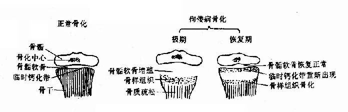 正常骨化和佝偻病时的变化