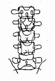 正位，椎弓根距离增大