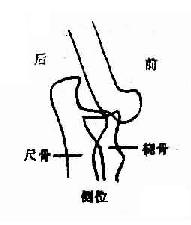 肘关节后脱位