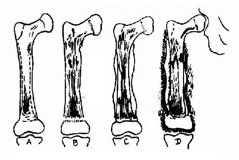 股骨急性血源性化脓性骨髓炎的病程各阶段改变