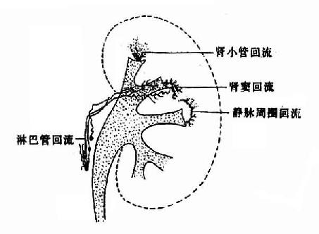 肾盂各种逆（回）流