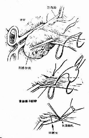 缝扎韧带及骨盆漏斗韧带