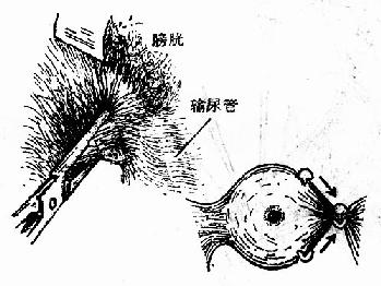 宫颈旁下钳法