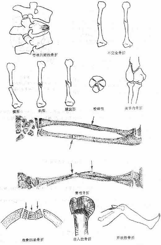 骨折类型