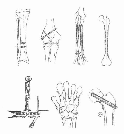 骨折内固定