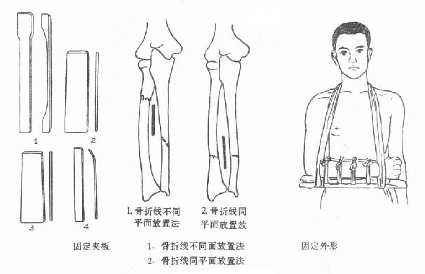 分肌垫放置法