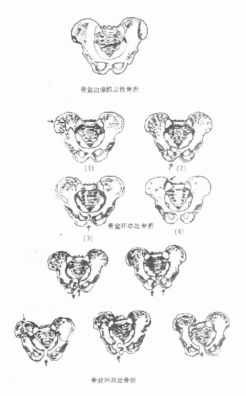 骨盆骨折