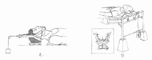 颈椎骨折脱位牵引复位