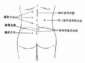 脊柱后凸的二种类型