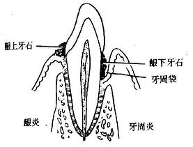 龈炎与牙周炎的区别