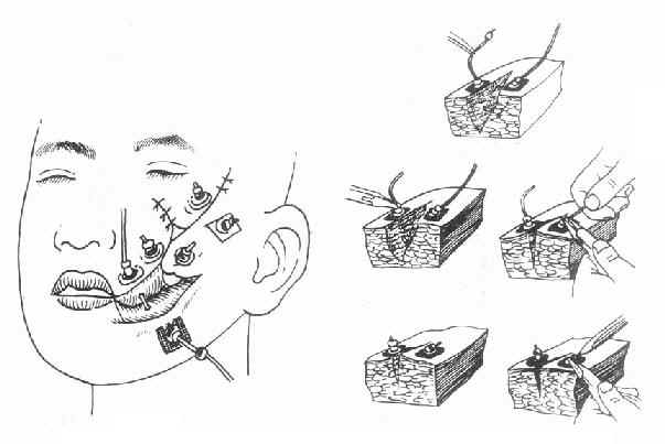 钢丝铅丸定向减张缝合