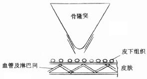 褥疮压迫图解