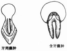 牙源性囊肿