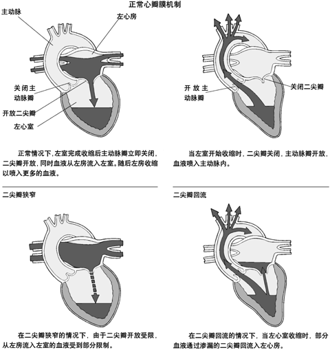 瓣膜狭窄与回流