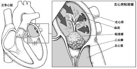 粘液瘤阻断心脏内的血流
