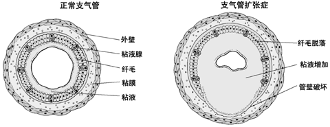 支气管扩张示意图