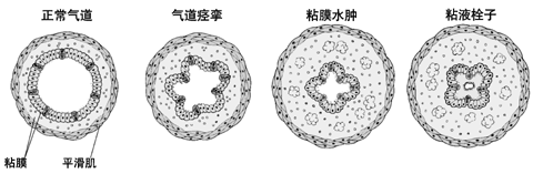 哮喘发作气道狭窄