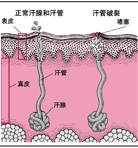 痱子的发生