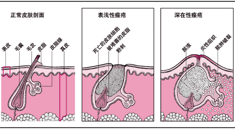 表浅性痤疮与深在性痤疮比较