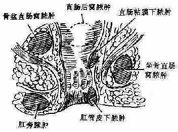 肛门直肠周围脓肿