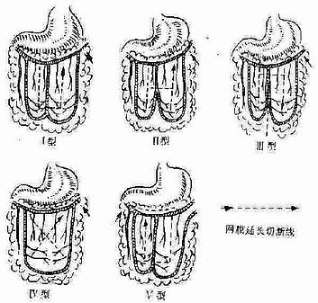 大网膜血管类型及延长方法