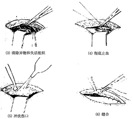 清创术基本步骤