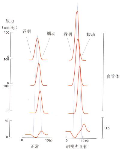 胡桃平食管病的测压结果图