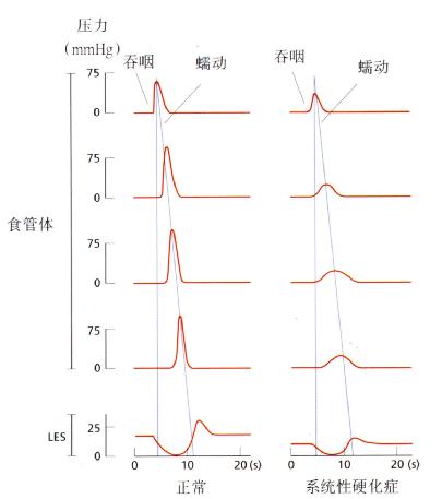 硬皮病患者的测压示意图