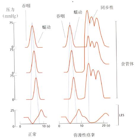 DES患者测压结果示意图