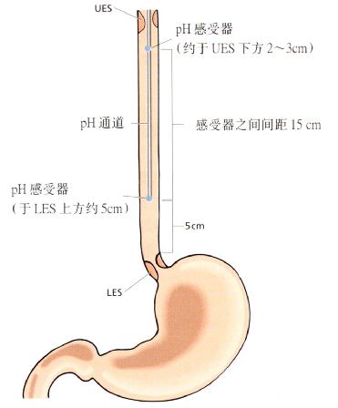 检测高位反流，pH感受器置于食管内的位置