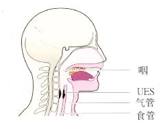 UES防止胃内容物反流