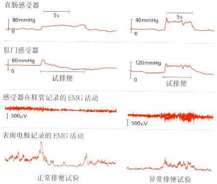 正常排便与盆底肌协调困难