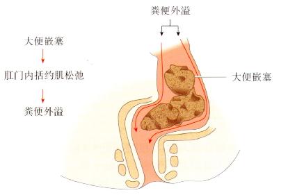 直肠内引起便秘的嵌塞大便