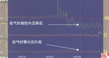 近端压力通道位于膈肌上方，图示吸气时压力下降