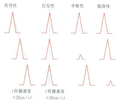 食管传导性、同步性、中断性、脱落性蠕动示意图