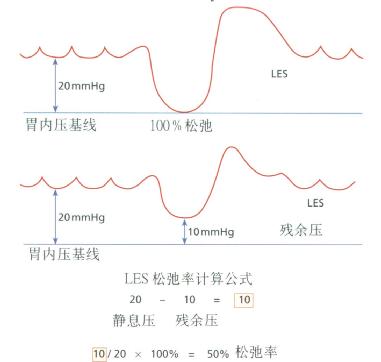 LES松弛率计算公式