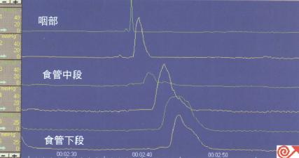 正常食管横纹肌与平滑肌交界处收缩幅度较低