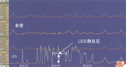 贲门失驰缓症患者食管测压