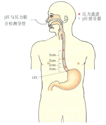 pH及动力联合检测导管置入位置