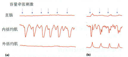 一例大便失禁患者的直肠括约肌反射