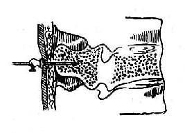棘突穿刺剖面