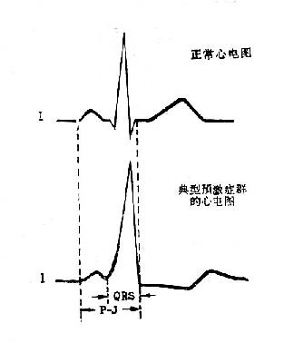 典型预激症候群心电图和正常心电图的比较