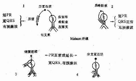 预缴综合征的解剖分类