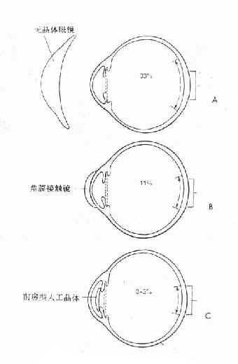 无晶体眼光学矫正